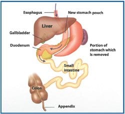 Sleeve Gastrectomy