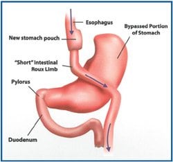 Gastric Bypass Surgery