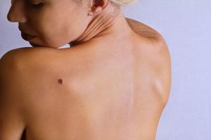 There are three major types of skin cancer. 