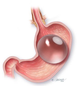 The ORBERA(TM) Intragastric Balloon System