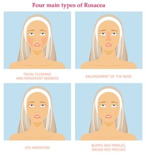 Four Main Types of Rosacea